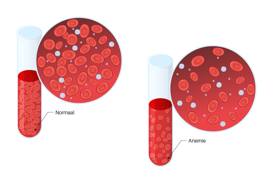 Troosteloos staan hersenen Wat is anemie (bloedarmoede)? | Sanquin